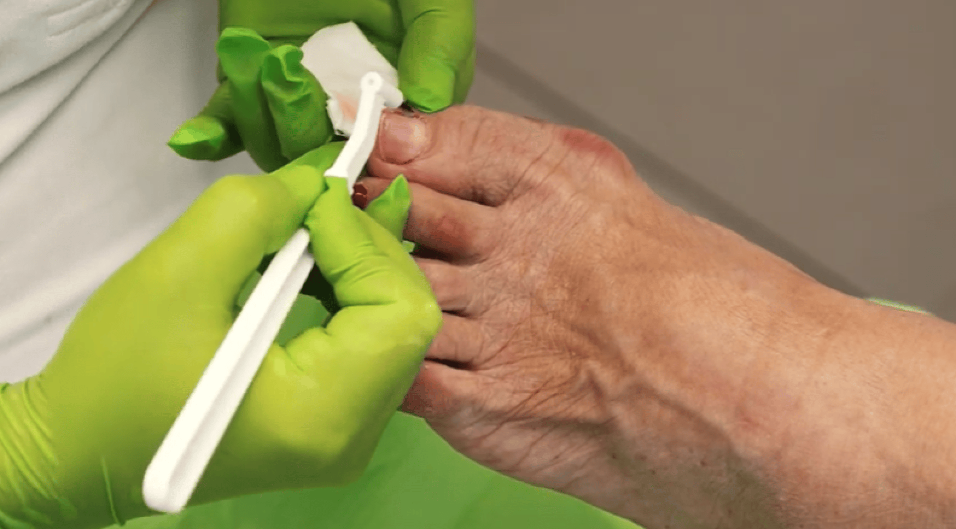 Eine Person mit grünen medizinischen Handschuhen reinigt oder behandelt mit einem kleinen Kunststoffinstrument einen Zehennagel.